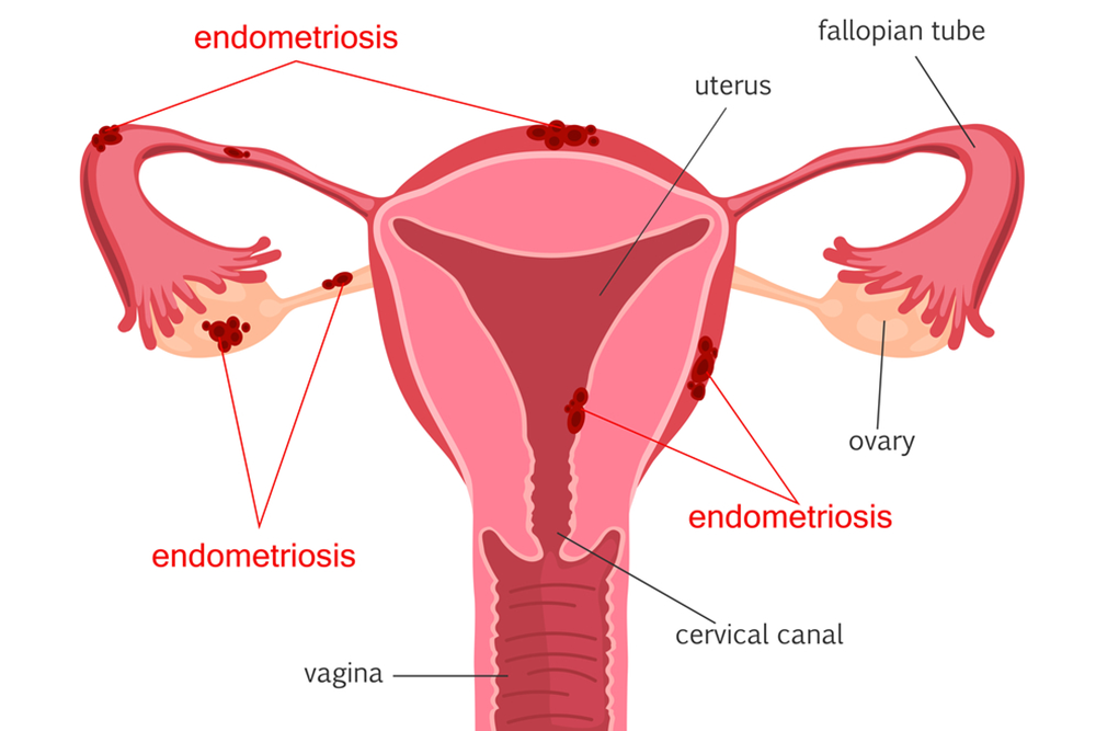 Ablation For Endometriosis: How It Can Alleviate Your Symptoms