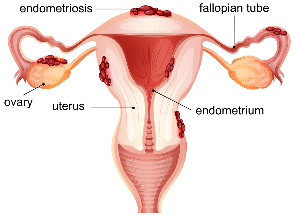 Adenomyosis Vs. Endometriosis: What's The Difference?