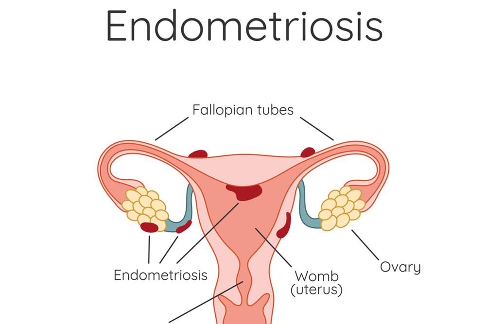 Can You Get Pregnant With Endometriosis?