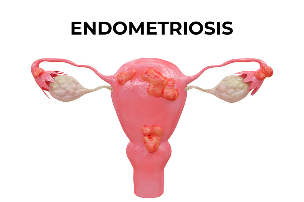 Relief On The Horizon: Exploring Promising Endometriosis Treatments