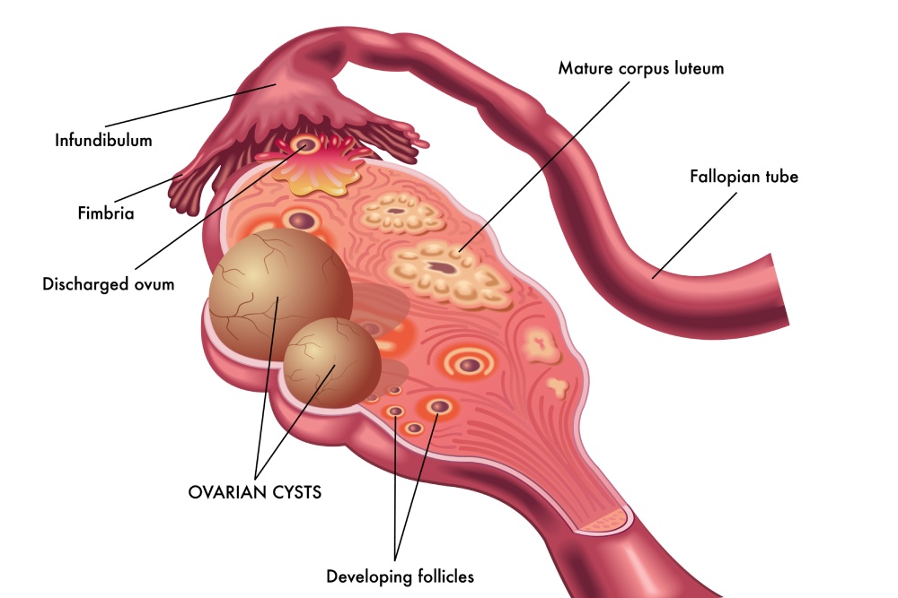 Get To Know About Ovarian Cysts After Menopause