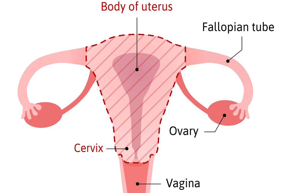 Understanding The Types Of Hysterectomy And Their Benefits